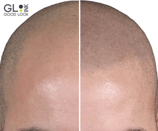 micropigmentation 